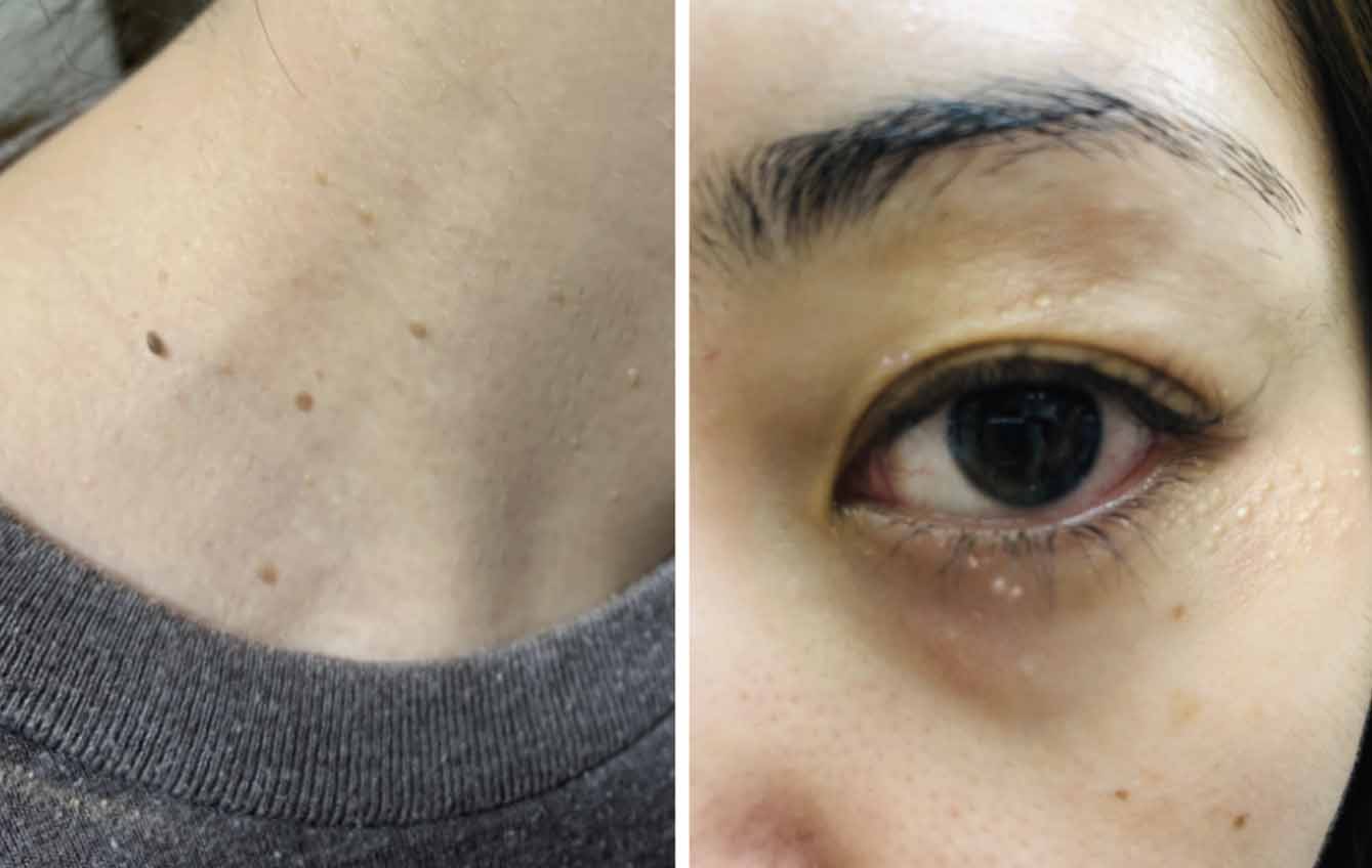 俏樂斯 曾沛慈 小綠餅 美白 抗皺 幼美肌 全方位保濕水凝霜 肉芽 顆粒 脂肪粒 醫美 電燒 除肉芽 淡化斑點 保濕 凝膠 沖繩 薏米 巴鈺