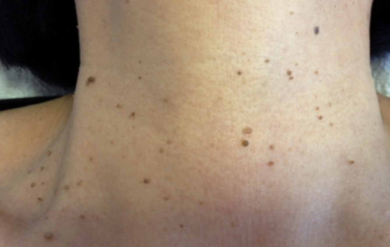 俏樂斯 曾沛慈 小綠餅 美白 抗皺 幼美肌 全方位保濕水凝霜 肉芽 顆粒 脂肪粒 醫美 電燒 除肉芽 淡化斑點 保濕 凝膠 沖繩 薏米 巴鈺