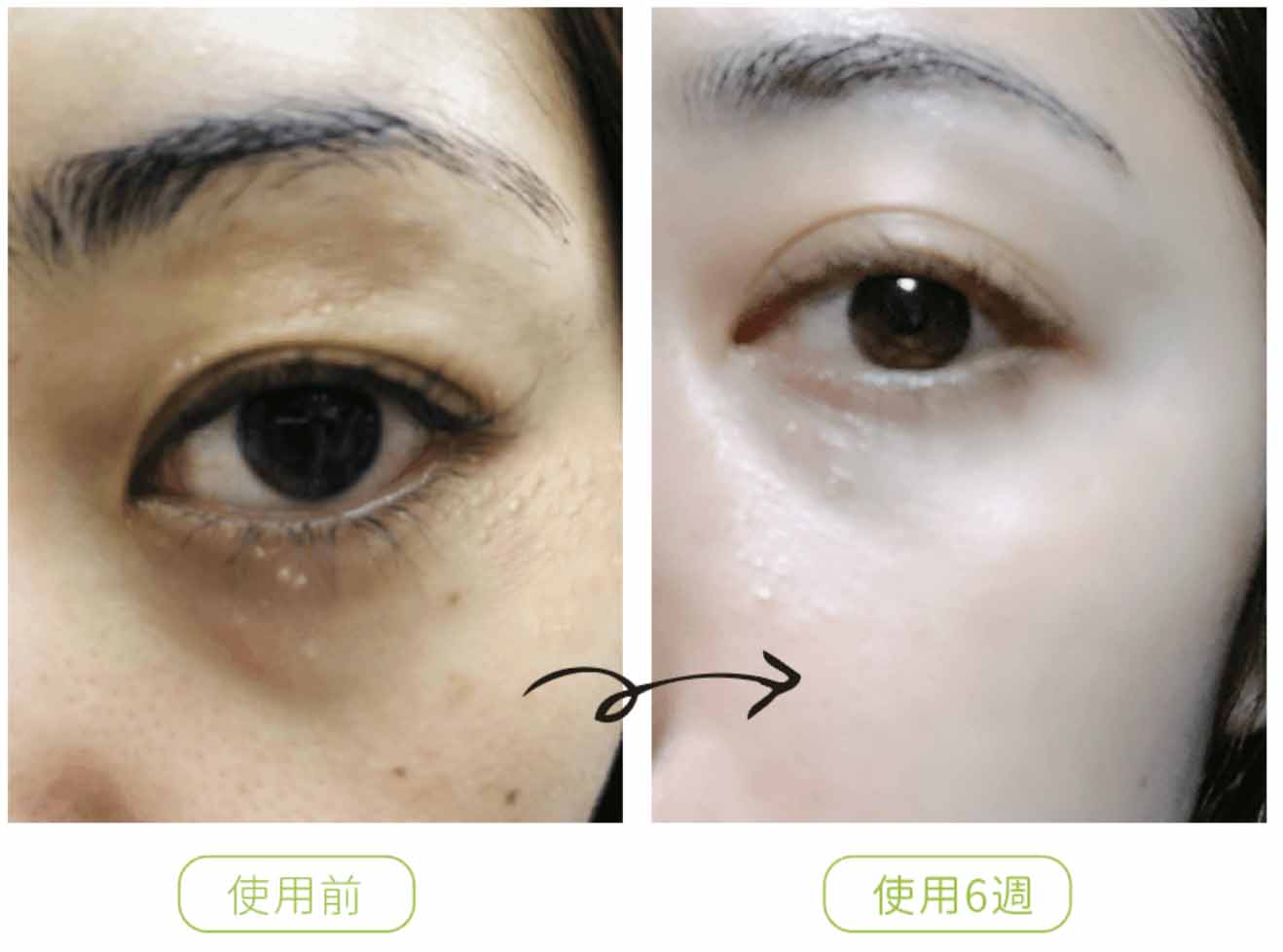 俏樂斯 曾沛慈 小綠餅 美白 抗皺 幼美肌 全方位保濕水凝霜 肉芽 顆粒 脂肪粒 醫美 電燒 除肉芽 淡化斑點 保濕 凝膠 沖繩 薏米 巴鈺