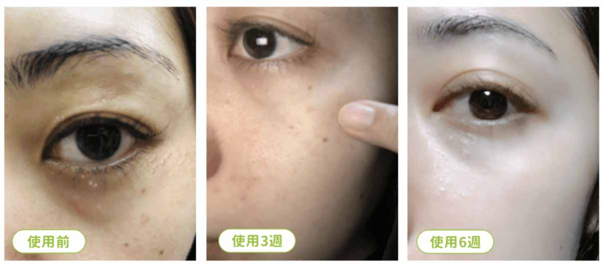 俏樂斯 曾沛慈 小綠餅 美白 抗皺 幼美肌 全方位保濕水凝霜 肉芽 顆粒 脂肪粒 醫美 電燒 除肉芽 淡化斑點 保濕 凝膠 沖繩 薏米 巴鈺