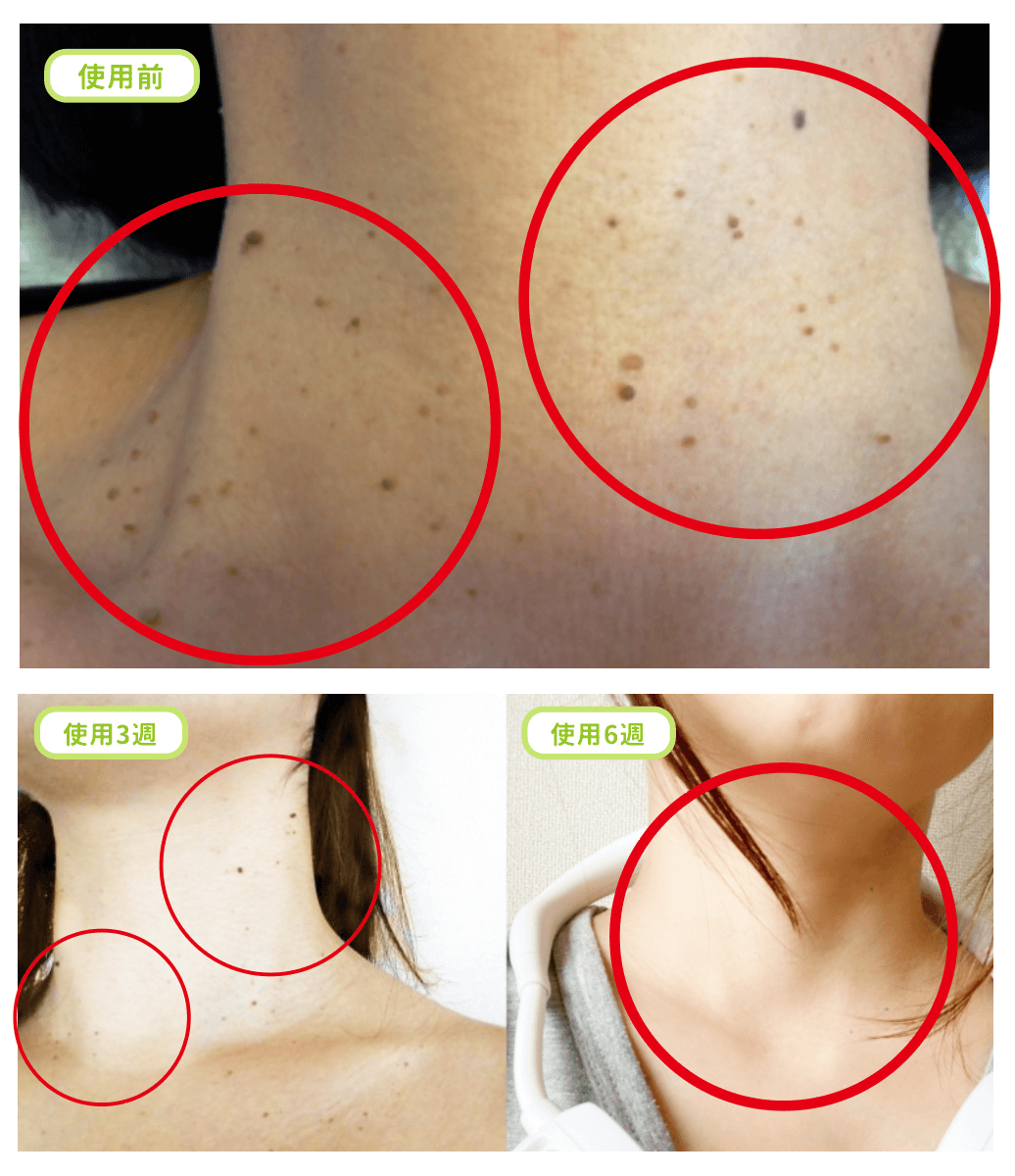 俏樂斯 曾沛慈 小綠餅 美白 抗皺 幼美肌 全方位保濕水凝霜 肉芽 顆粒 脂肪粒 醫美 電燒 除肉芽 淡化斑點 保濕 凝膠 沖繩 薏米 巴鈺