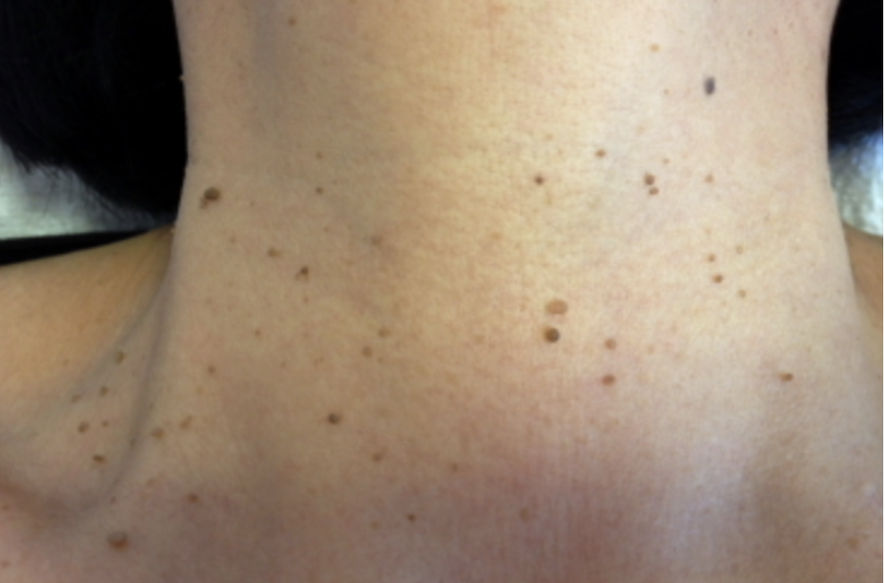 俏樂斯 曾沛慈 小綠餅 美白 抗皺 幼美肌 全方位保濕水凝霜 肉芽 顆粒 脂肪粒 醫美 電燒 除肉芽 淡化斑點 保濕 凝膠 沖繩 薏米 巴鈺