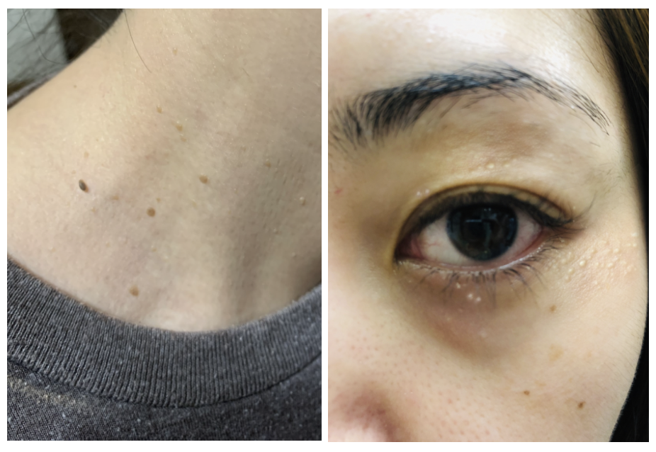 俏樂斯 曾沛慈 小綠餅 美白 抗皺 幼美肌 全方位保濕水凝霜 肉芽 顆粒 脂肪粒 醫美 電燒 除肉芽 淡化斑點 保濕 凝膠 沖繩 薏米 巴鈺