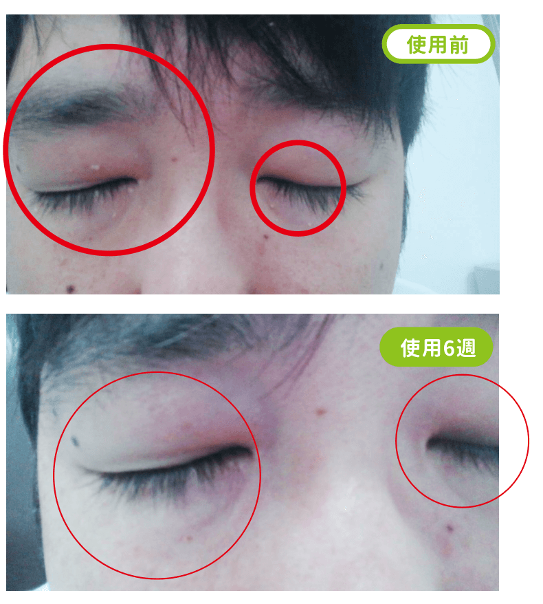 俏樂斯 曾沛慈 小綠餅 美白 抗皺 幼美肌 全方位保濕水凝霜 肉芽 顆粒 脂肪粒 醫美 電燒 除肉芽 淡化斑點 保濕 凝膠 沖繩 薏米