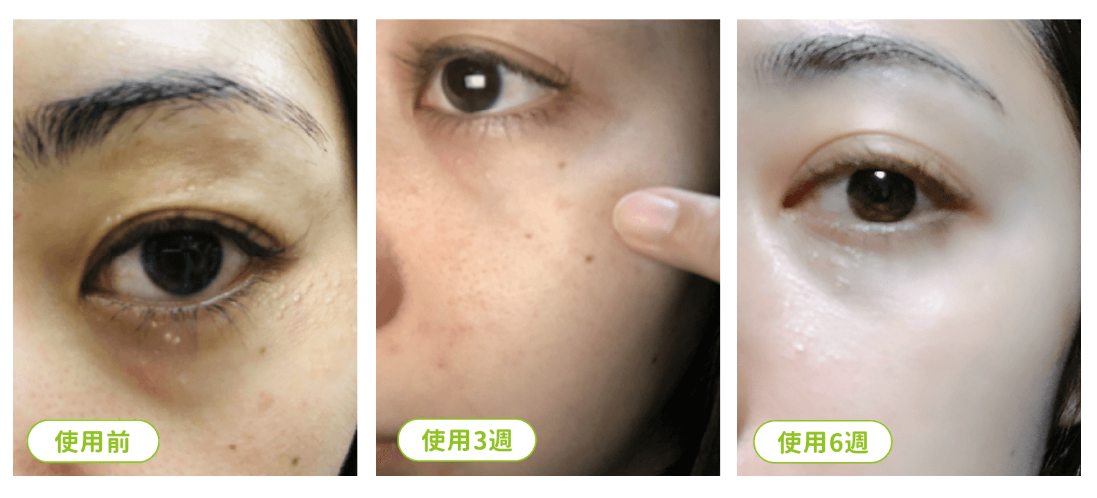 俏樂斯 曾沛慈 小綠餅 美白 抗皺 幼美肌 全方位保濕水凝霜 肉芽 顆粒 脂肪粒 醫美 電燒 除肉芽 淡化斑點 保濕 凝膠 沖繩 薏米 巴鈺