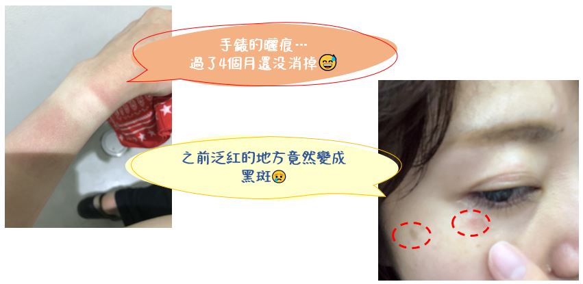 曬黑 曬傷 黑斑