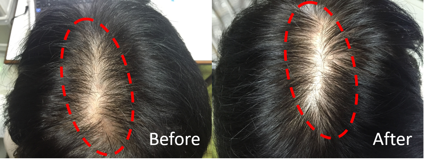 多立寶 東森 多髮寶 生髮 養髮 健髮 育髮 掉髮 CSC 落髮 一袋女王 生髮專家 禿頭