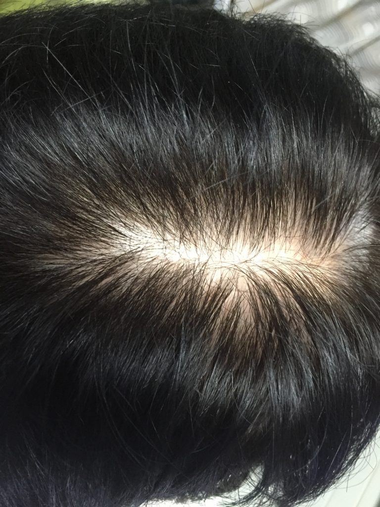 多立寶 東森 多髮寶 生髮 養髮 健髮 育髮 掉髮 CSC 落髮 一袋女王 生髮專家 禿頭