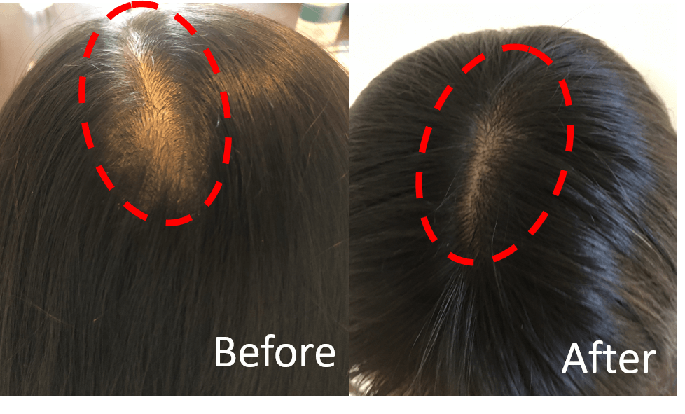 多立寶 東森 多髮寶 生髮 養髮 健髮 育髮 掉髮 CSC 落髮 一袋女王 生髮專家 禿頭