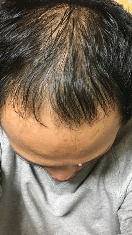 多立寶 東森 多髮寶 生髮 養髮 健髮 育髮 掉髮 CSC 落髮 一袋女王 生髮專家 禿頭