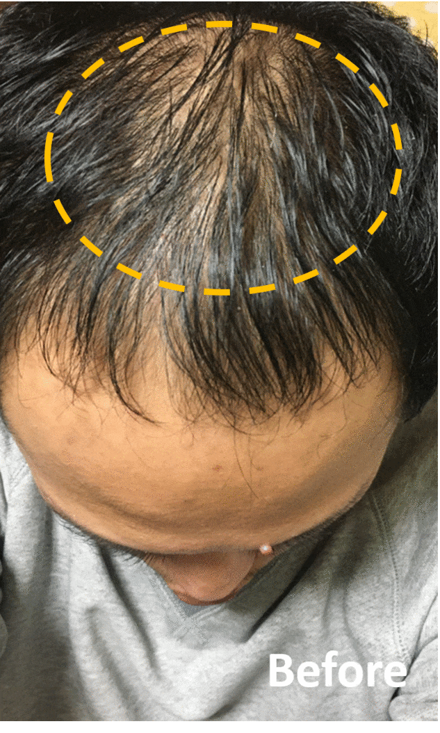 多立寶 東森 多髮寶 生髮 養髮 健髮 育髮 掉髮 CSC 落髮 一袋女王 生髮專家 禿頭