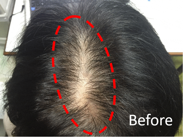 多立寶 東森 多髮寶 生髮 養髮 健髮 育髮 掉髮 CSC 落髮 一袋女王 生髮專家 禿頭