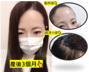 多立寶 東森 多髮寶 生髮 養髮 健髮 育髮 掉髮 CSC 落髮 一袋女王 生髮專家 禿頭