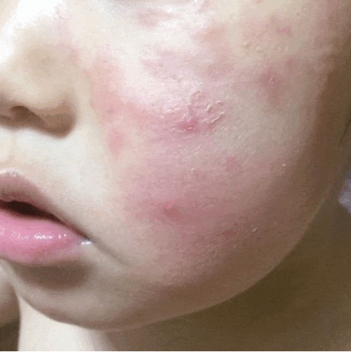 一個月的時間,涼介的皮膚就從發紅過敏變穩定的平滑肌膚了。